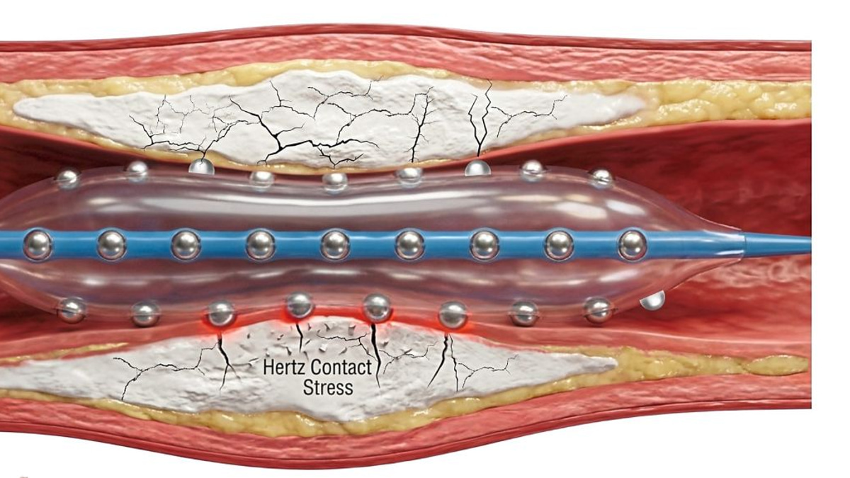 Malaysian Cardiologists Pioneer Advanced Plaque-Busting Technology for Hardened Arteries