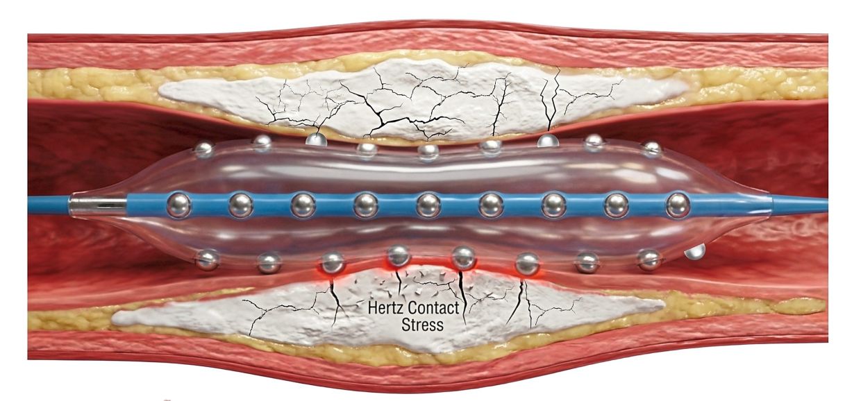 Malaysian Cardiologists Pioneer Advanced Plaque-Busting Technology for Hardened Arteries